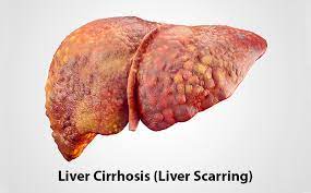 Liver Cirrhosis