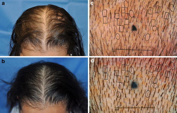 effective ways to treat hair loss