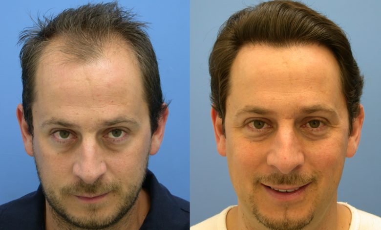 Cheap Hair Transplant Los Angeles