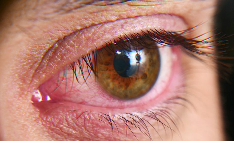 Dry eyes featured image